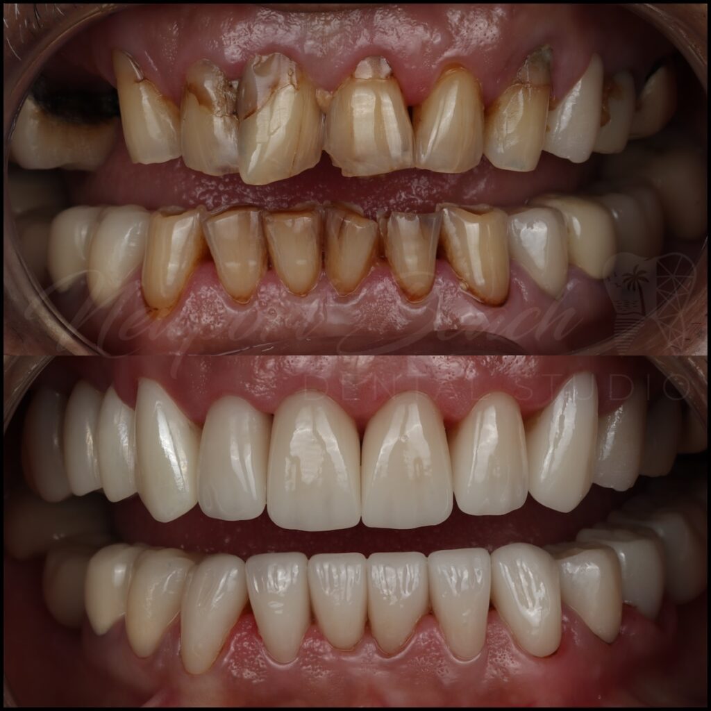 Full-Mouth Rehabilitation With E.max & Zirconia Restorations
