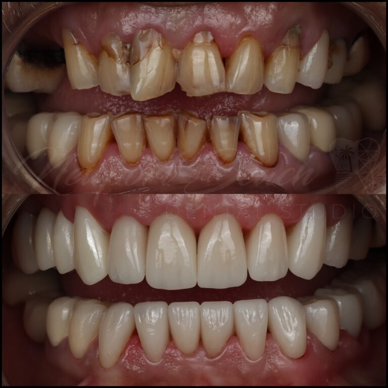 Before and after full-mouth rehabilitation using E.max veneers, E.max crowns and zirconia bridges at Newport Beach Dental Studio