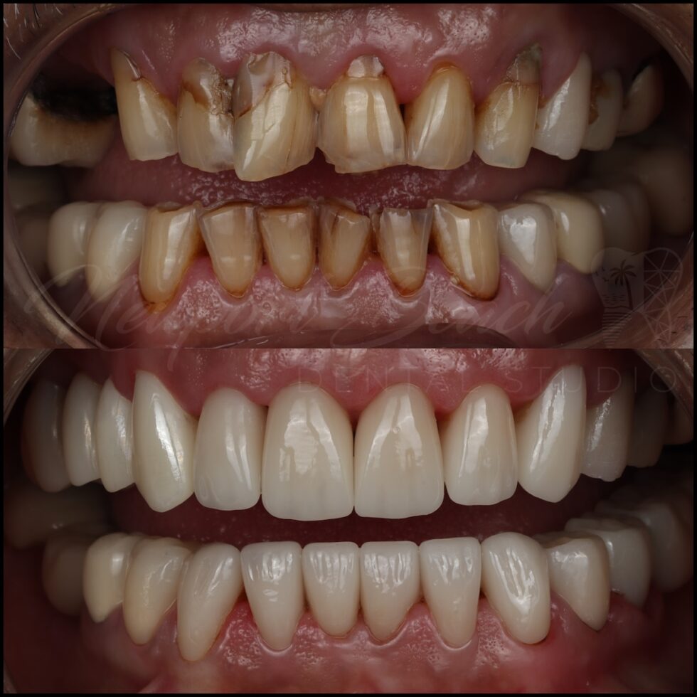 full mouth rehab dr tai ha newport beach