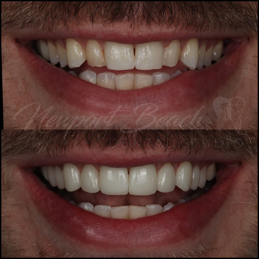 10 No-Prep Injectable Composite Veneers
