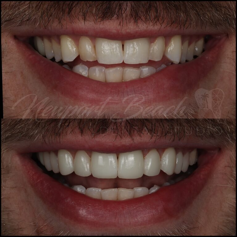 Before and after 10 no-prep injectable composite veneers from teeth 4 through 13 at Newport Beach Dental Studio