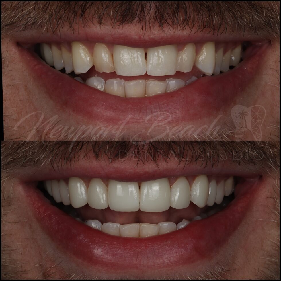 Before and after 10 no-prep injectable composite veneers from teeth 4 through 13 at Newport Beach Dental Studio