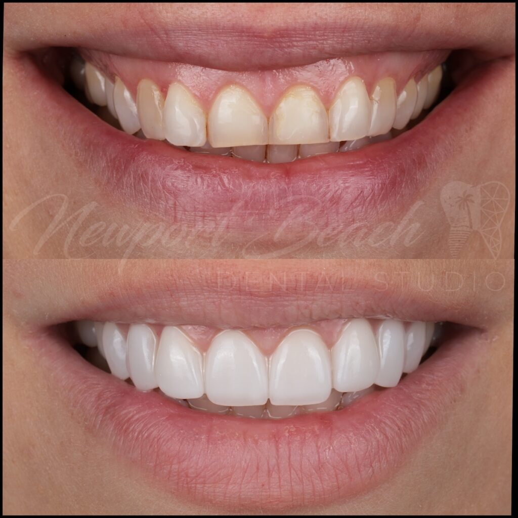 10 Prepless UltraThineers With No Tooth Shaving