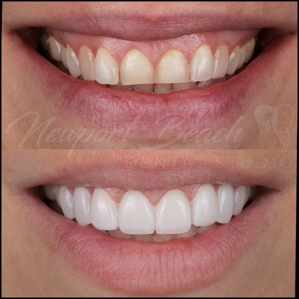 Before and after 10 prepless UltraThineer zirconia veneers at Newport Beach Dental Studio