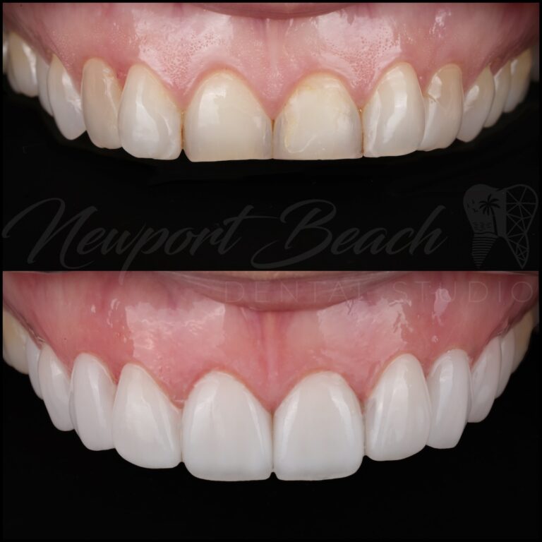 Close-up before and after of 10 ultra-thin 3D-printed zirconia veneers for worn and discolored teeth