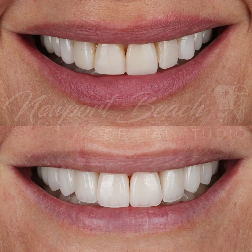 Before and after replacement of six aging veneers with eight layered E.max BL4 HT veneers improving tooth proportions, black triangles, buccal corridors and smile harmony at Newport Beach Dental Studio