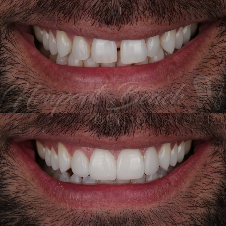 Before and after four no-prep feldspathic porcelain veneers improving gaps, uneven tooth proportions, symmetry and smile harmony at Newport Beach Dental Studio