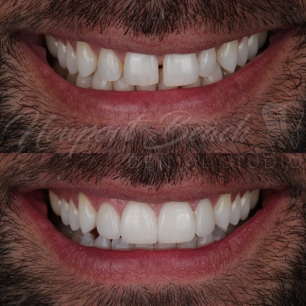 Before and after four no-prep feldspathic porcelain veneers improving gaps, uneven tooth proportions, symmetry and smile harmony at Newport Beach Dental Studio