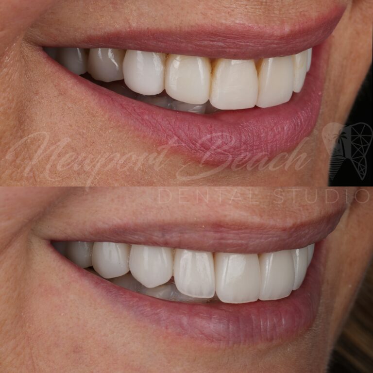 Oblique before and after view of eight layered E.max BL4 HT veneers showing improved lateral smile fullness, tooth contours and buccal corridor reduction at Newport Beach Dental Studio