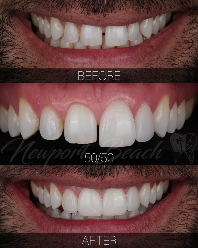 Before 50/50 and after comparison of four no-prep feldspathic veneers showing improved tooth size, spacing, symmetry and anterior smile proportions