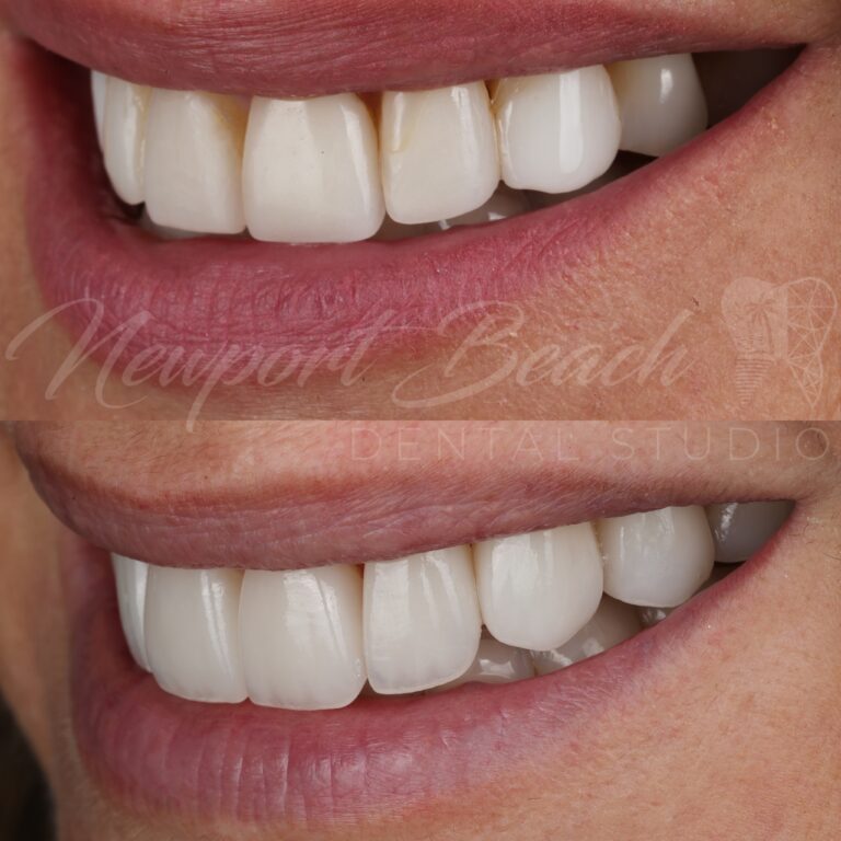 Oblique before and after view of eight layered E.max BL4 HT veneers showing improved lateral smile fullness, tooth contours and buccal corridor reduction at Newport Beach Dental Studio