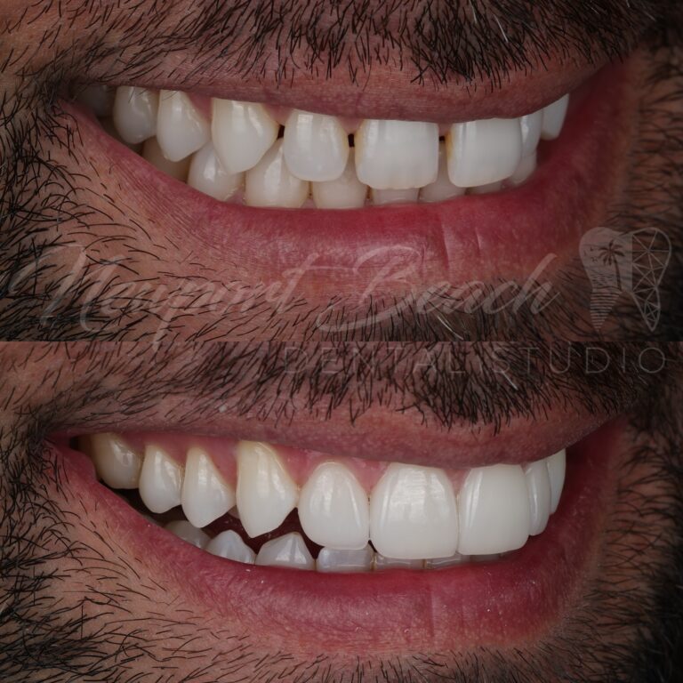 Oblique before and after view of four no-prep feldspathic veneers demonstrating improved tooth proportions, alignment and natural integration with surrounding teeth