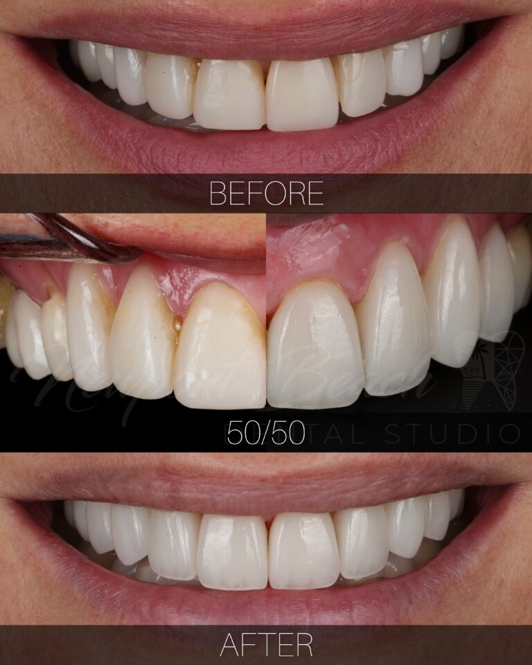 Before 50/50 and after comparison of six aging veneers replaced with eight layered E.max BL4 HT veneers showing improved translucency, black triangles, proportions and gingival transitions