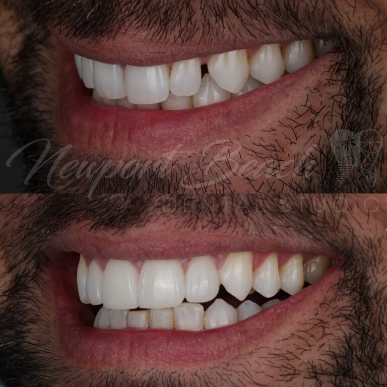 Opposite oblique before and after view of four no-prep feldspathic veneers showing improved anterior tooth symmetry, contours and smile continuity