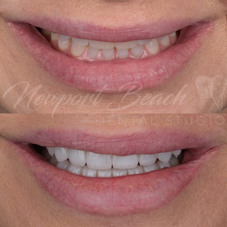 eMax Veneers Tai Ha DDS