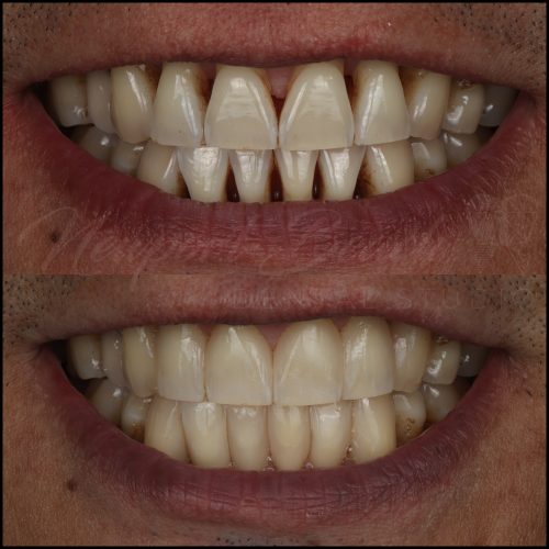 Before and after Bioclear black triangle treatment by Dr. Tai Ha in Newport Beach
